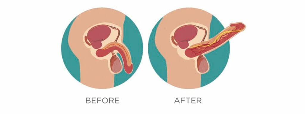 Before & After Erectile Dysfunction Treatment In Uae
